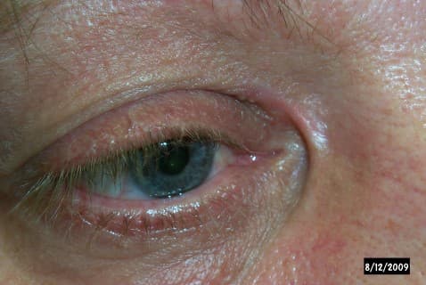 Medial canthal web לאחר ניתוח עפעף — קפל עור אנכי על פני הפינה הפנימית