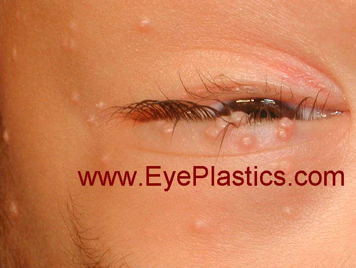 病变 molluscum contagiosum על העפלף