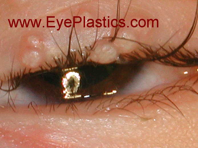 molluscum contagiosum &mdash; התפלגות סביב העין