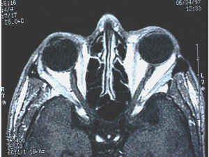 Axial CT scan of the orbit